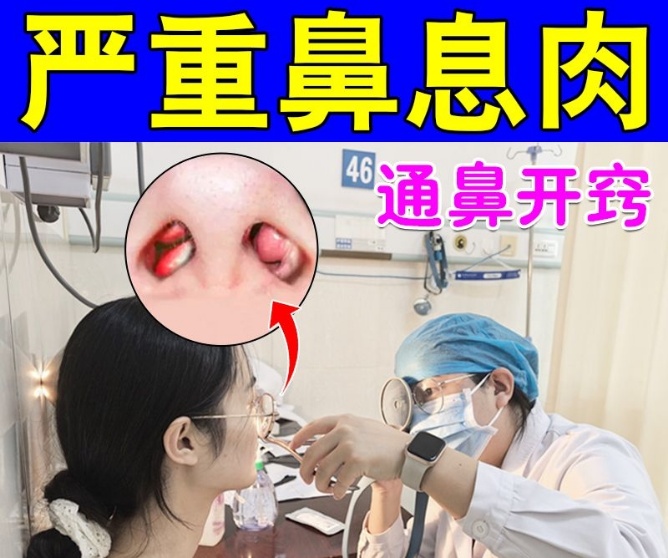 鼻息肉不激光 不腐蚀抹药几天