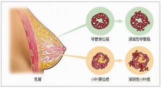 治疗乳腺疾癌的秘方和针灸